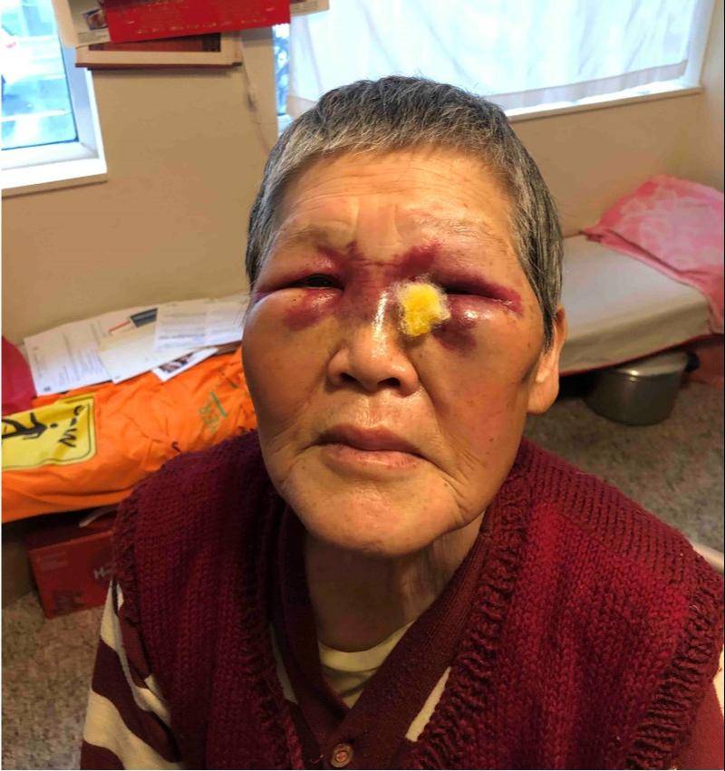 76岁华裔老太街头反抗白人袭击 2万美国网友给捐款治伤